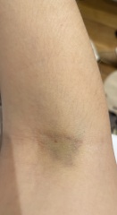 Excess bruising? Am I just a peach?