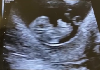 Any sonographers here? 17mm MSD gestational sac no fetal pole?