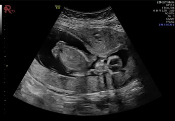 14 weeks and 3 days
