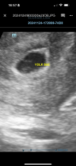 Early pregnancy scan worry