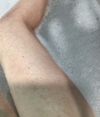 Chapped legs