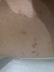 Is this Scabies…?