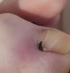 Should I see a GP with this toenail thing (pictures included)?
