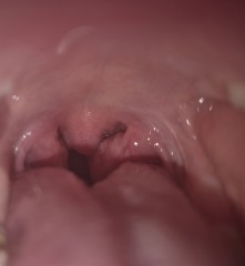 Tonsils picture please help!