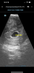 Early pregnancy scan worry