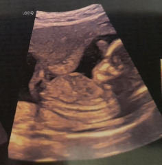 Guess the gender: boy or swollen girl.