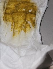 Breast fed Baby Poos WARNING IMAGES ATTACHED ?CMPA