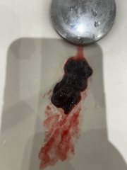Passing these clots