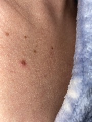 Strange mole