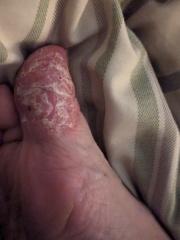 What cream to use on this ore toe ?