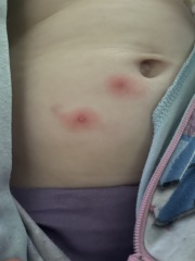 Help! Red pus spots on 5 year old