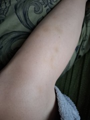 Bruises all over legs!