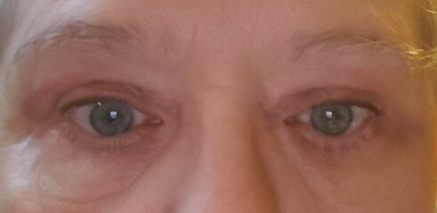 Blepharoplasty with local anesthesia
