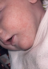 Neocate rash?