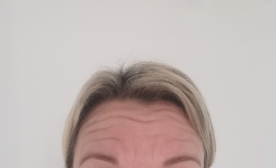 Will botex or anything help these forehead lines? ad