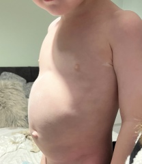 Bloated tummy in toddler.