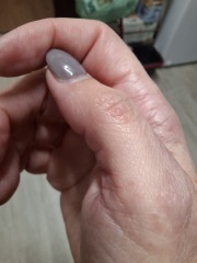 Hand infected (Warning, gross photos)