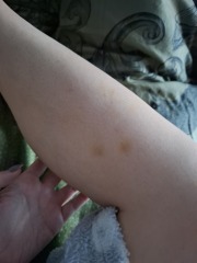 Bruises all over legs!