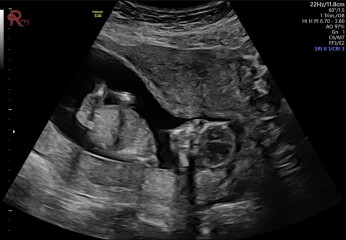 14 weeks and 3 days