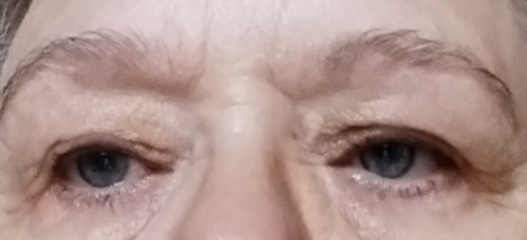 Blepharoplasty with local anesthesia