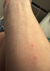 Any ideas on my rash?