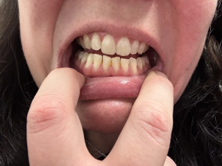 Health anxiety regarding teeth