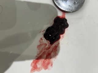 Passing these clots