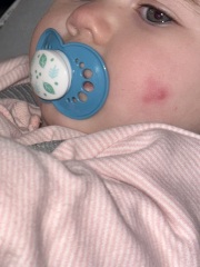 Worried about this rash/spot on babies face