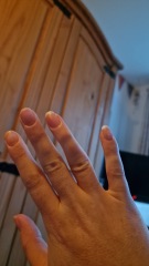 Both ring fingers are crooked.