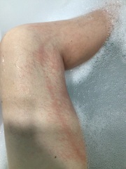 Chapped legs