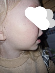 Chicken pox? Hand foot and mouth?