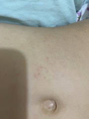 Is this a scabies rash or something else?(photos included)
