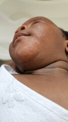 3 months old baby rash