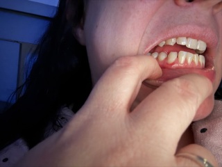 Is this gingivitis?