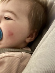 Worried about this rash/spot on babies face