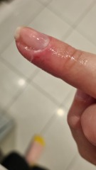 My finger is so sodding sore