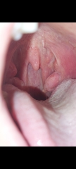 Growth on tonsil 2 week referral - help!