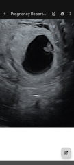 Possible mo-mo or mo-di twins after our embryo split