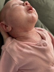 5 week old, Is this baby acne?
