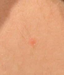 Chicken pox or bug bites?
