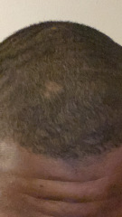 Bald spots on my head