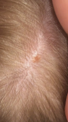 Scabies in nursery