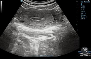 negative pregnancy test positive ultrasound