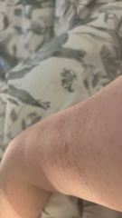 Is this a mole?