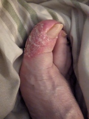 What cream to use on this ore toe ?