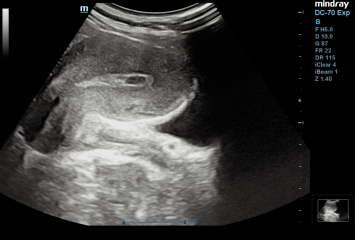 negative pregnancy test positive ultrasound