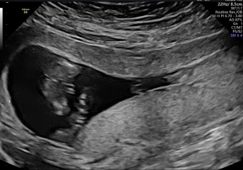 Potty shot - cord or boy?