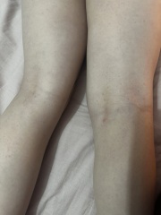 Could anyone advise what this rash could be please?