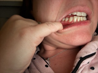 Is this gingivitis?