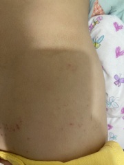 Is this a scabies rash or something else?(photos included)